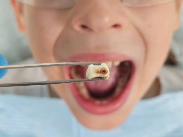 Best Emergency Tooth Extraction in Washington, WV